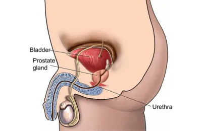 LAPAROSCOPIC RADICAL PROSTATECTOMY