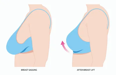 BREAST LIFT SURGERY