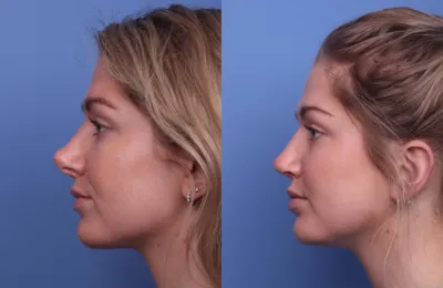 RHINOPLASTY