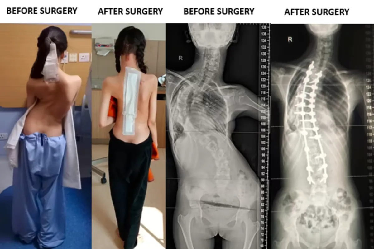 SCOLIOSIS SURGEY