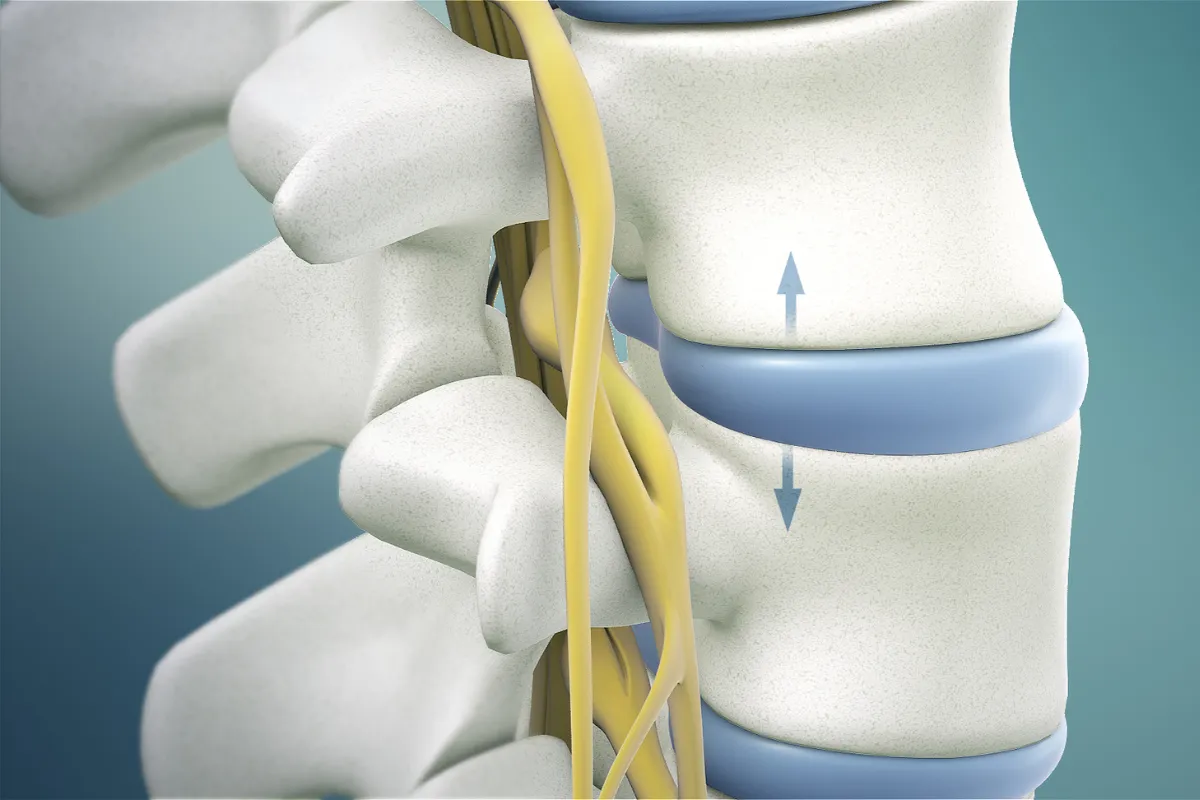 SPINAL DECOMPRESSION