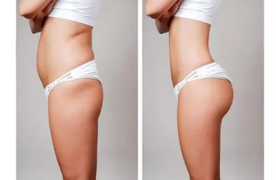 BUTTLIFT SURGERY