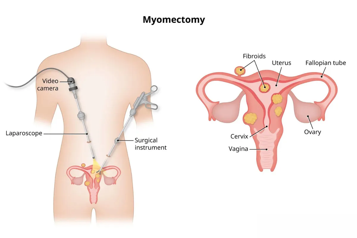 FIBOID REMOVAL