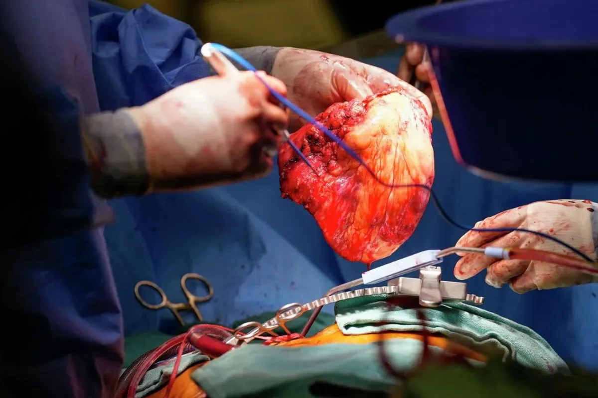 HEART TRANSPLANT