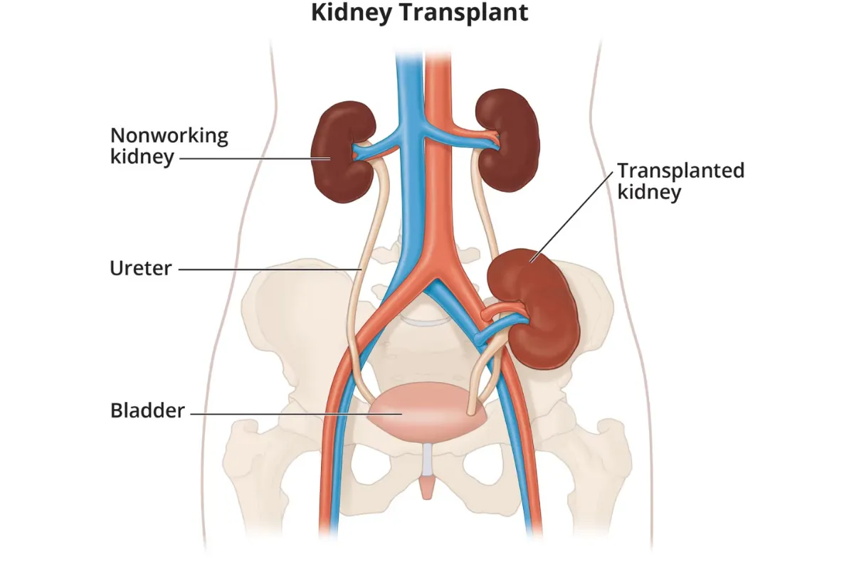 KIDNEY TRANSPLANT