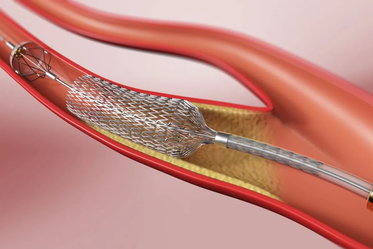 CAROTID ANGIOPLASTY