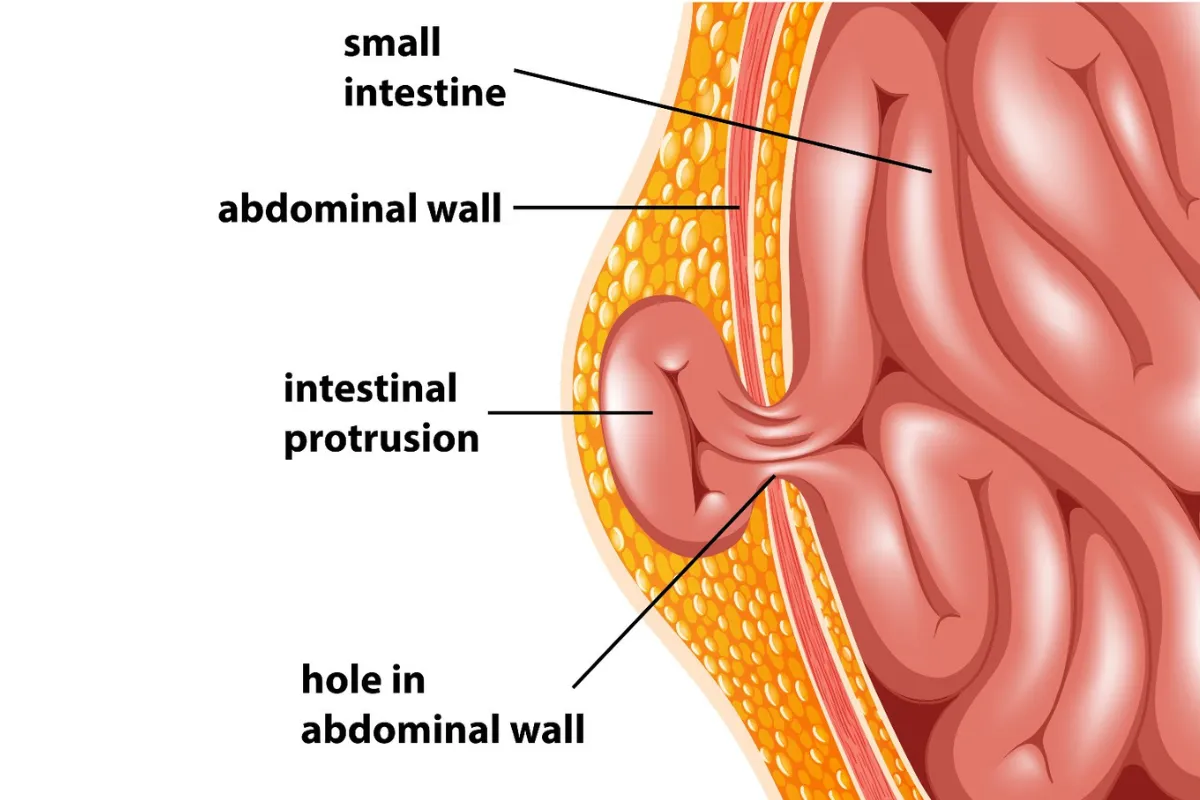 HERNIA