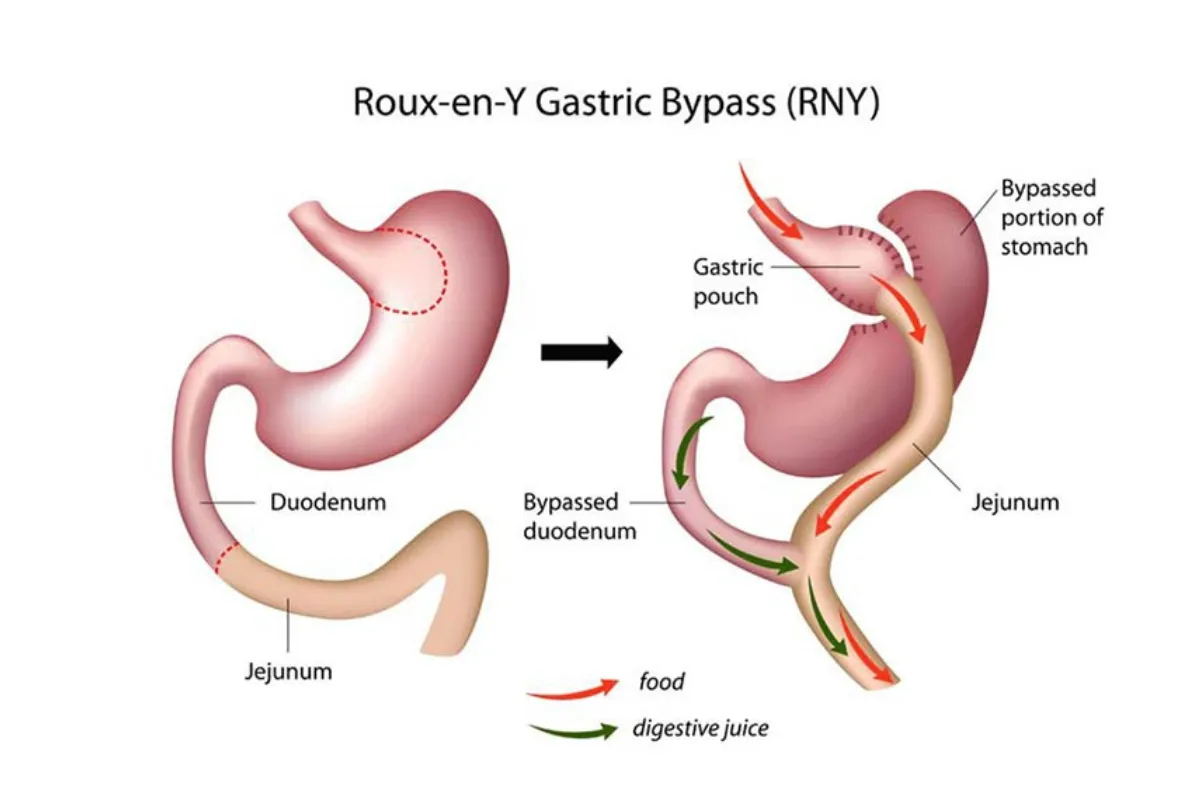 GASTRIC BYPASS