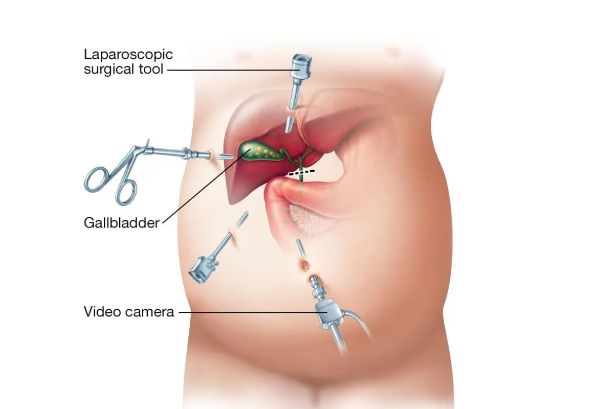 GALL STONE REMOVAL