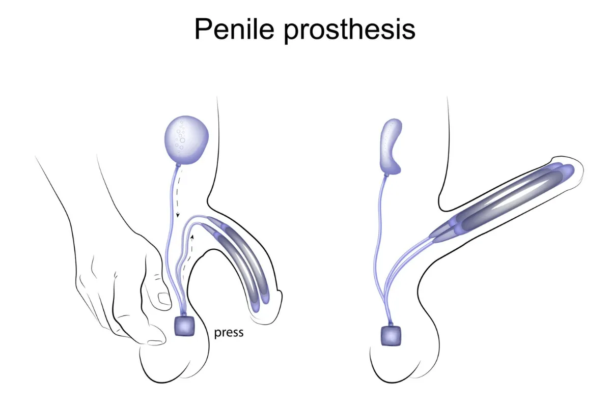 PENILE IMPLANT