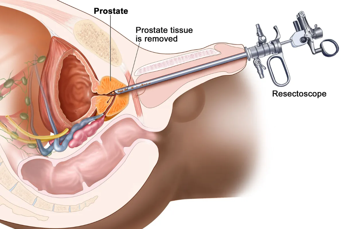 PROSTATE REMOVAL