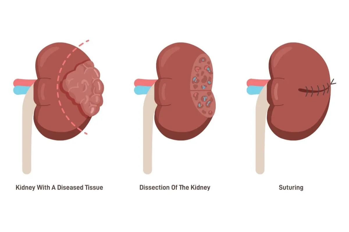 NEPHRACTOMY