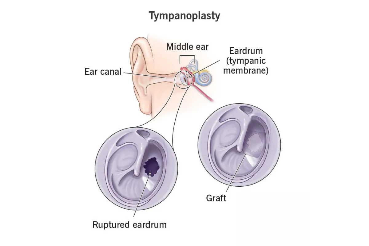 TYMPANOPLASTY