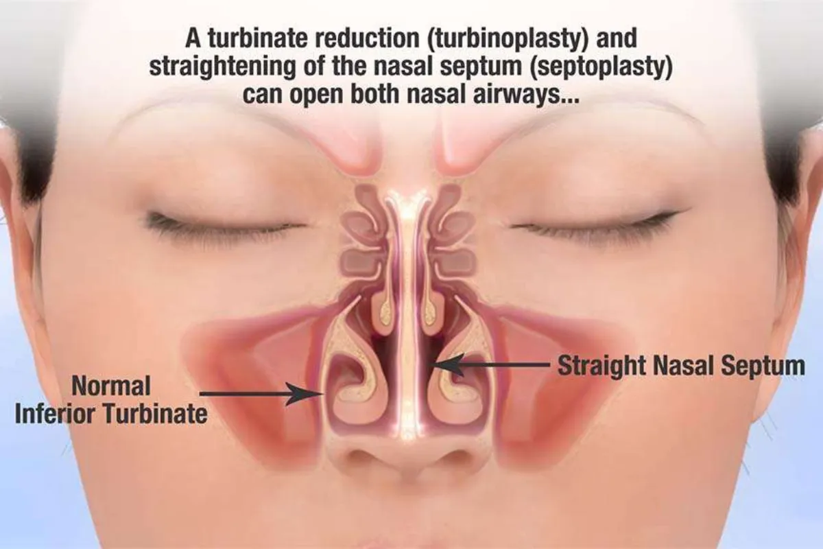 SEPTOPLASTY