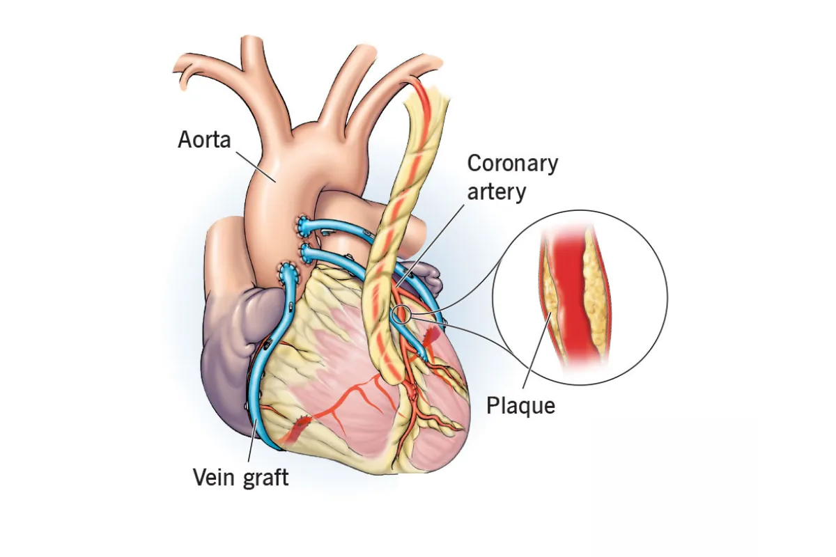 CABG