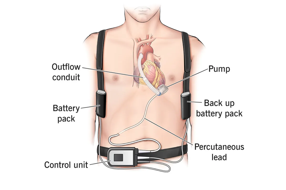 LEFT VENTRICULAR ASSIST DEVICE (LVAD) IMPLANTATION SURGERY 