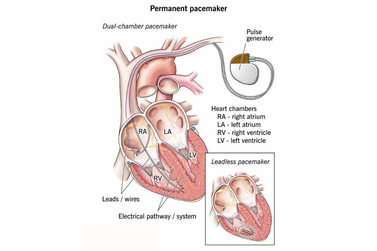 PACEMAKER IMPLANTATION