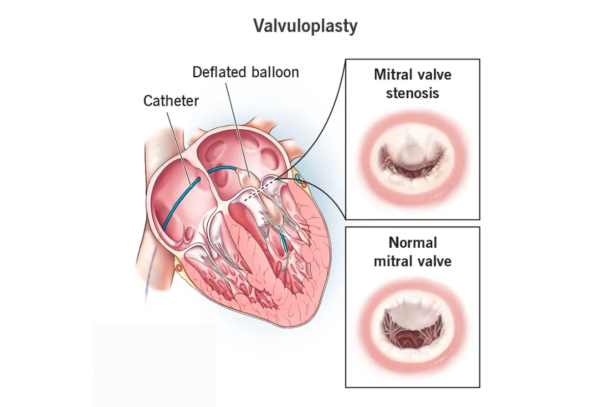 BALOON VALVULOPLASTY