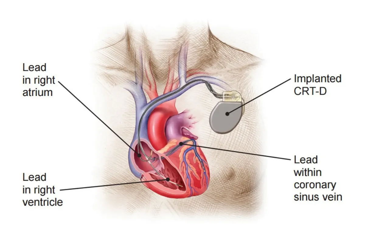 CRT - D IMPLANTATION