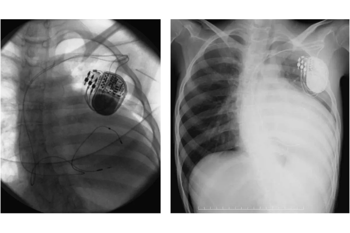 CRT - P IMPLANTATION