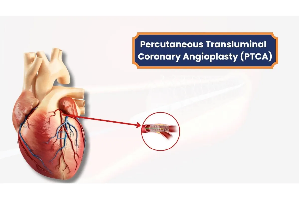 PTCA(ANGIOPLASTY )