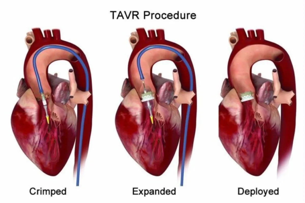 TRANS AORTIC VALVE IMPLANTATION (TAVI/TAVR)