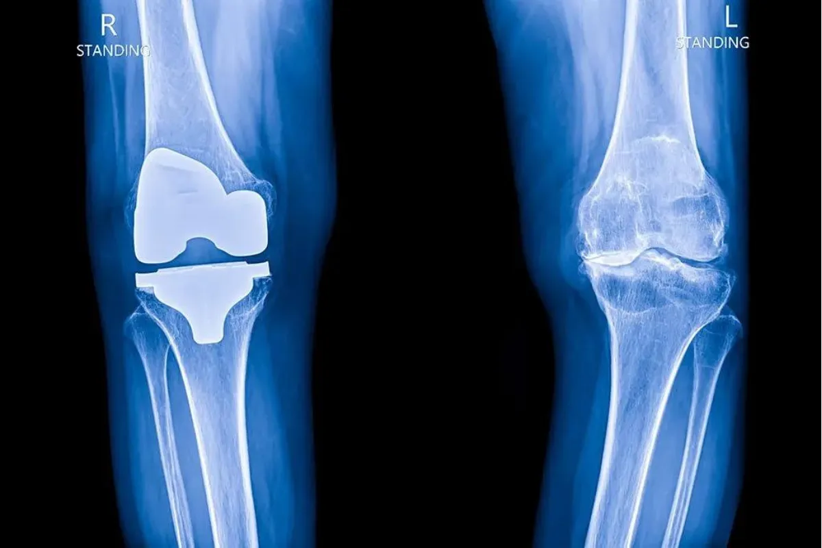 KNEE REPLACEMENT