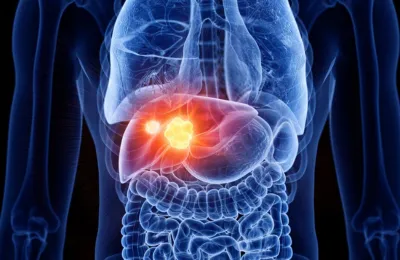 LIVER CANCER