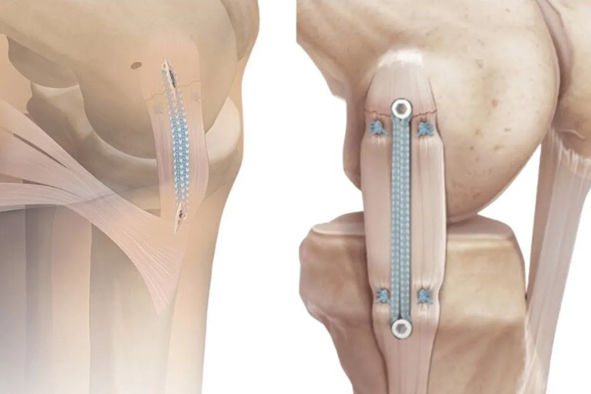 MCL RECONSTRUCTION