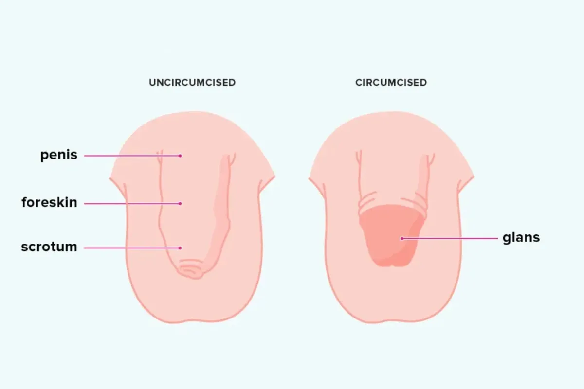 CIRCUMCISION