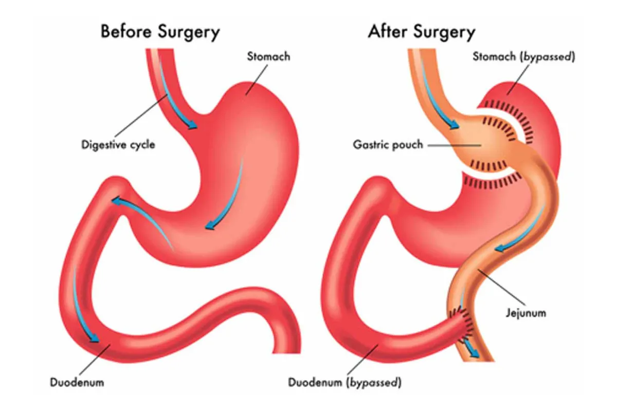 GASTRIC BYPASS
