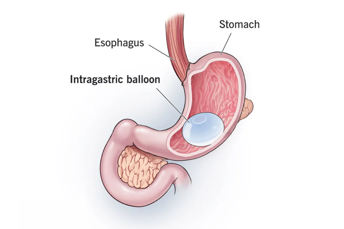 INTRAGASTRIC BALLOONING