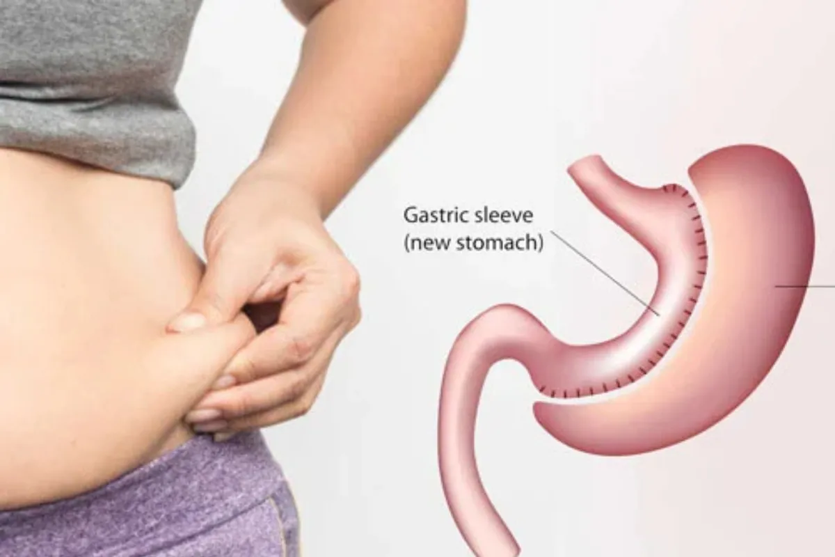 SLEEVE GASTRECTOMY