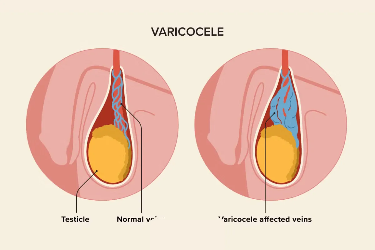 VARICOCELE